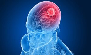 tumor
